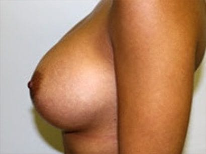 A woman with breast implants is shown in this picture.