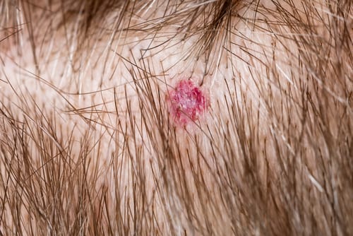 A close up of the back end of a person 's head with an abscess on it.