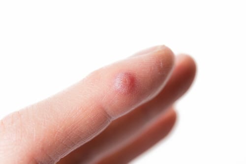 A person with a small red spot on their finger.