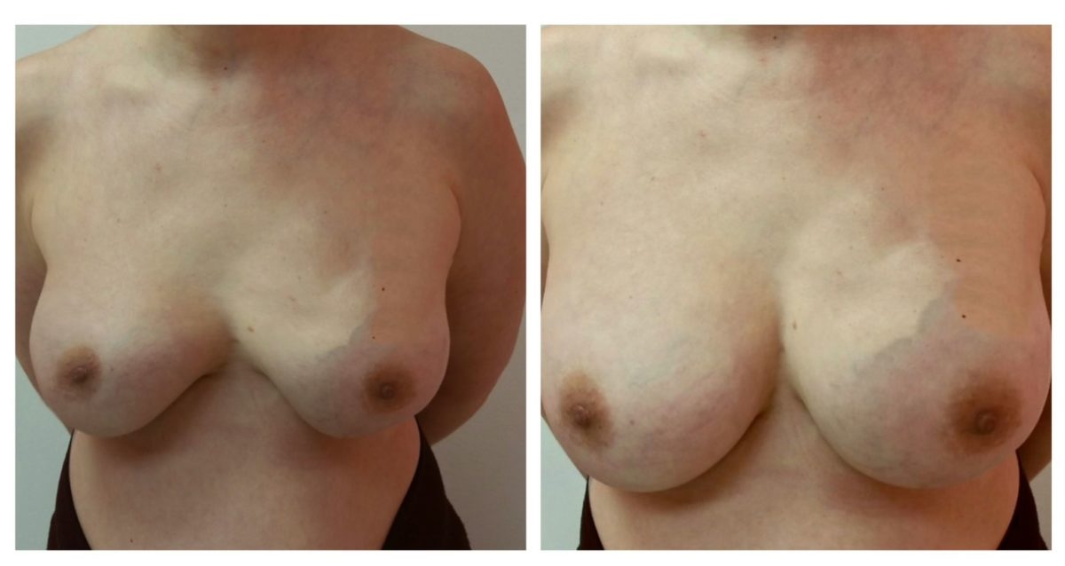 A before and after photo of a woman 's breast.