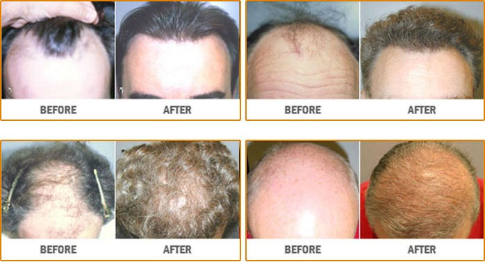 Hair Transplant Neo Graft in Toronto | La Fontaine Cosmetic Surgery