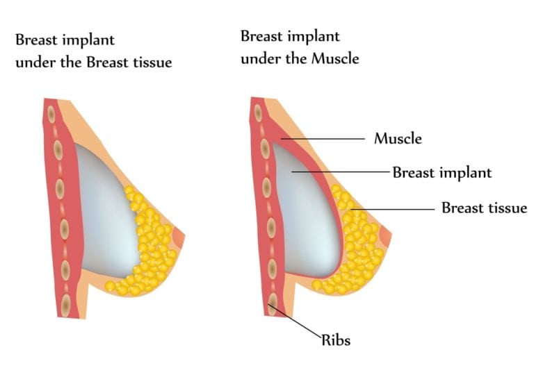 A diagram of breast implant implantation and muscle implantation.