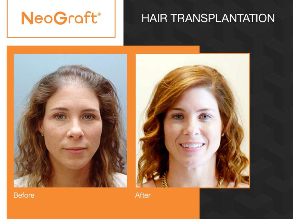Hair Transplant Neo Graft in Toronto | La Fontaine Cosmetic Surgery