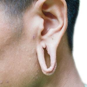 A man with his ear cut off and showing the front part of his ear.