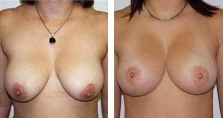 A woman with breast implants and before and after.