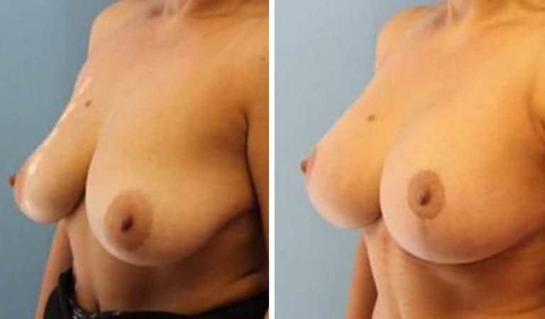 Breast Augmentation before and after