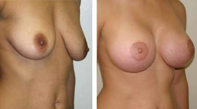 A woman with breast implants and before and after.