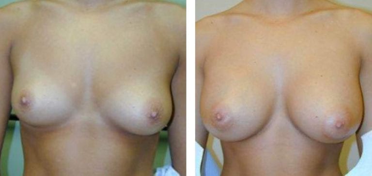 Breast Augmentation before and after