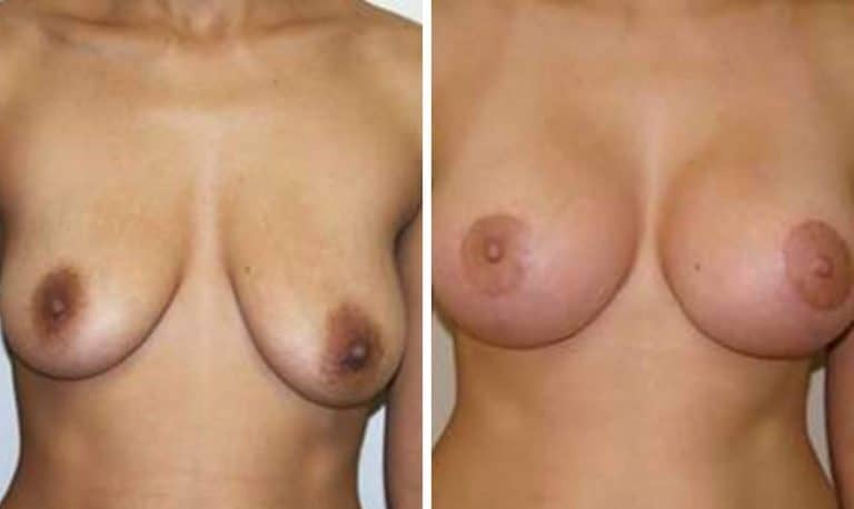 A before and after picture of breast augmentation surgery.