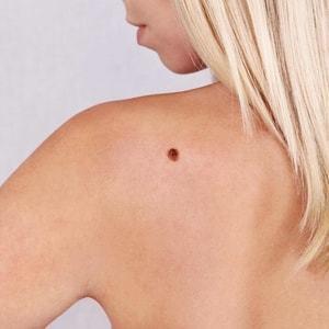 A woman with a black spot on her shoulder.