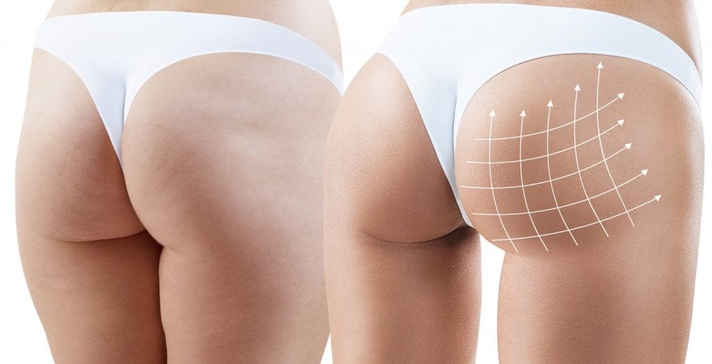 Brazilian Buttock Lift (BBL) in Toronto