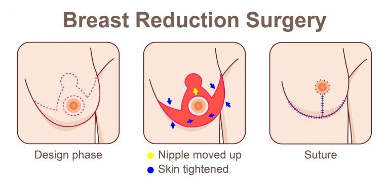 A diagram of the process of breast reduction surgery.