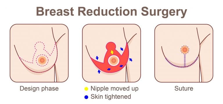 Breast Reduction - Brand Surgical Institute