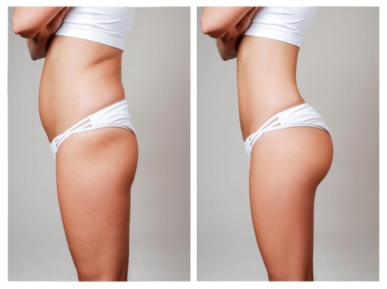 🥇 Can you make a BBL smaller? Why are women seeking liposuction after BBL  (Brazilian butt lift)?