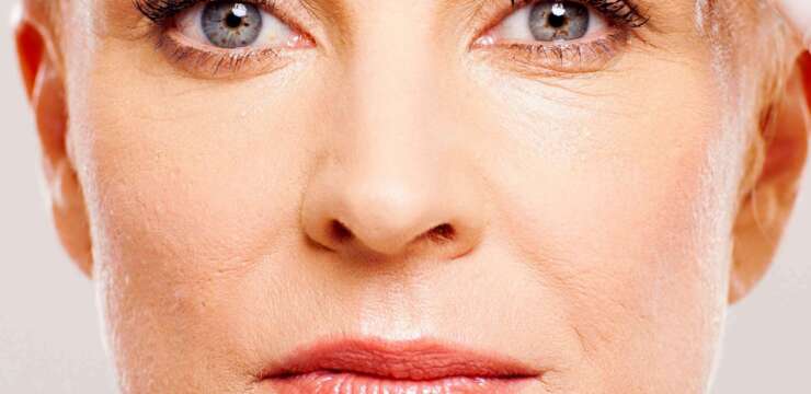 Fractional Resurfacing Lasers Treat Acne Scarring