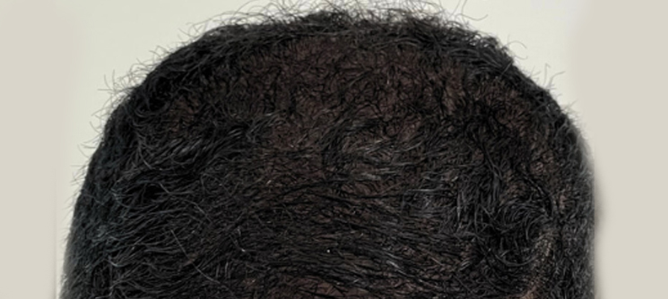 A close up of the hair on someone 's head