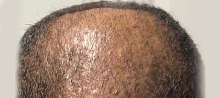 A close up of the hair on a man 's head