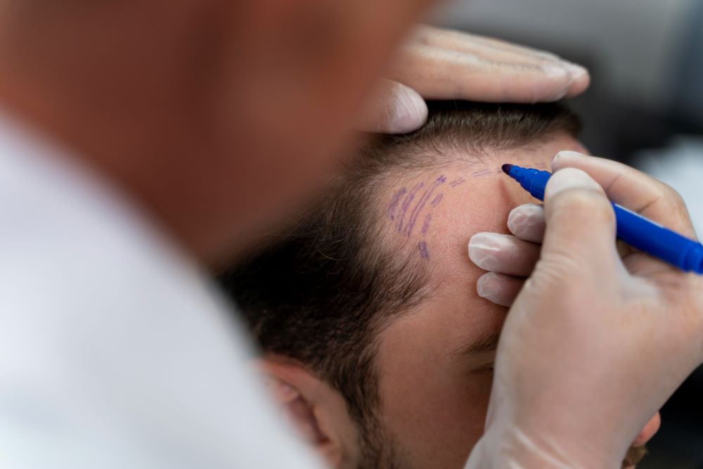 A man is getting his hair cut by an acupunct